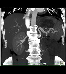 Left Nephrectomy - CTisus CT Scan