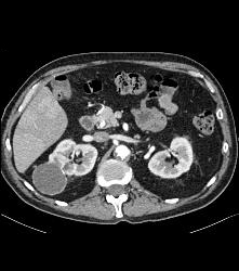 Cystic Renal Cell Carcinoma - CTisus CT Scan