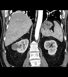 Cystic Renal Cell Carcinoma - CTisus CT Scan