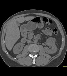 Cystic Renal Cell Carcinoma - CTisus CT Scan