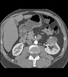 Cystic Renal Cell Carcinoma - CTisus CT Scan