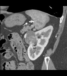 Cystic Renal Cell Carcinoma - CTisus CT Scan