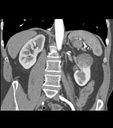 Cystic Renal Cell Carcinoma - CTisus CT Scan