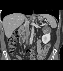 Cystic Renal Cell Carcinoma - CTisus CT Scan