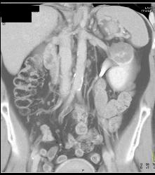 Cystic Renal Cell Carcinoma - CTisus CT Scan