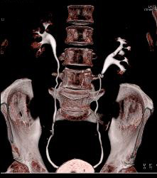 Cystic Renal Cell Carcinoma - CTisus CT Scan