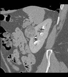 Cystic Renal Cell Carcinoma - CTisus CT Scan