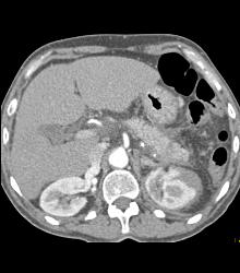 Left Pararenal Hematoma - CTisus CT Scan