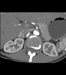 Subtle 1cm Renal Cell Carcinoma Best Seen on Late Phase Images- See Full Sequence for Best Definition - CTisus CT Scan