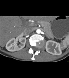 Subtle 1cm Renal Cell Carcinoma Best Seen on Late Phase Images- See Full Sequence for Best Definition - CTisus CT Scan