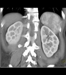 Subtle 1cm Renal Cell Carcinoma Best Seen on Late Phase Images- See Full Sequence for Best Definition - CTisus CT Scan