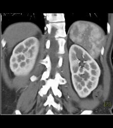 Subtle 1cm Renal Cell Carcinoma Best Seen on Late Phase Images- See Full Sequence for Best Definition - CTisus CT Scan