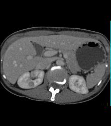 Subtle 1cm Renal Cell Carcinoma Best Seen on Late Phase Images- See Full Sequence for Best Definition - CTisus CT Scan