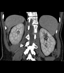 Subtle 1cm Renal Cell Carcinoma Best Seen on Late Phase Images- See Full Sequence for Best Definition - CTisus CT Scan