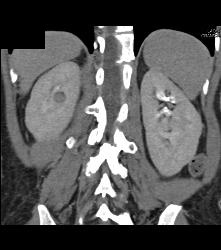 Subtle 1cm Renal Cell Carcinoma Best Seen on Late Phase Images- See Full Sequence for Best Definition - CTisus CT Scan