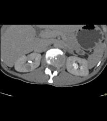 Subtle 1cm Renal Cell Carcinoma Best Seen on Late Phase Images- See Full Sequence for Best Definition - CTisus CT Scan