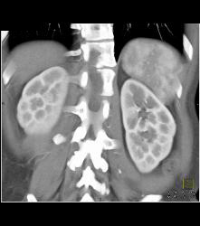 Subtle 1cm Renal Cell Carcinoma Best Seen on Late Phase Images- See Full Sequence for Best Definition - CTisus CT Scan