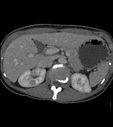 Subtle 1cm Renal Cell Carcinoma Best Seen on Late Phase Images- See Full Sequence for Best Definition - CTisus CT Scan