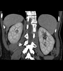 Subtle 1cm Renal Cell Carcinoma Best Seen on Late Phase Images- See Full Sequence for Best Definition - CTisus CT Scan