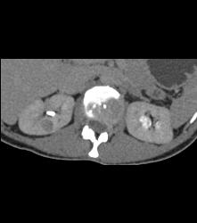 Subtle 1cm Renal Cell Carcinoma Best Seen on Late Phase Images- See Full Sequence for Best Definition - CTisus CT Scan