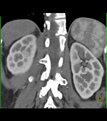 Subtle 1cm Renal Cell Carcinoma Best Seen on Late Phase Images- See Full Sequence for Best Definition - CTisus CT Scan