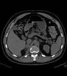 Right Adrenal Bleed Extends Near the Kidney - CTisus CT Scan