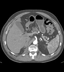 Right Adrenal Bleed Extends Near the Kidney - CTisus CT Scan