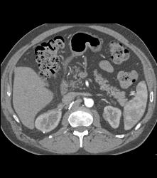 Right Adrenal Bleed Extends Near the Kidney - CTisus CT Scan