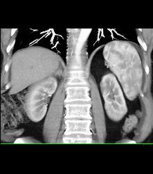 Right Adrenal Bleed Extends Near the Kidney - CTisus CT Scan