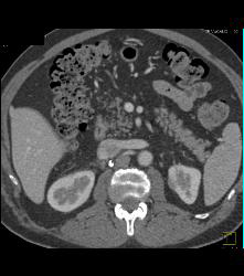 Right Adrenal Bleed Extends Near the Kidney - CTisus CT Scan