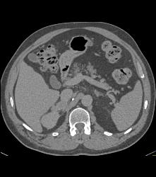 Right Adrenal Bleed Extends Near the Kidney - CTisus CT Scan