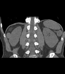 Dense Renal Cyst - CTisus CT Scan