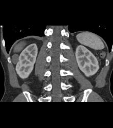 Dense Renal Cyst - CTisus CT Scan