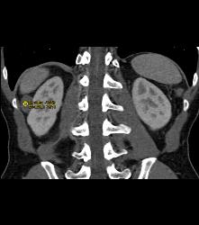 Dense Renal Cyst - CTisus CT Scan