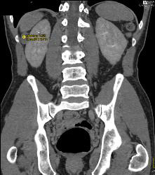 Dense Renal Cyst - CTisus CT Scan