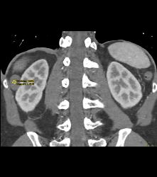 Dense Renal Cyst - CTisus CT Scan