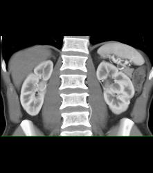 Dense Renal Cyst - CTisus CT Scan