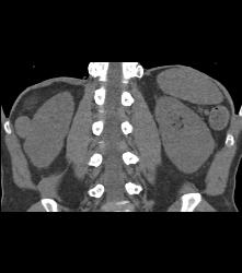 Dense Renal Cyst - CTisus CT Scan