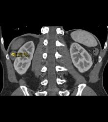 Dense Renal Cyst - CTisus CT Scan