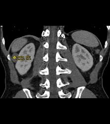 Dense Renal Cyst - CTisus CT Scan