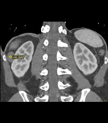 Dense Renal Cyst - CTisus CT Scan