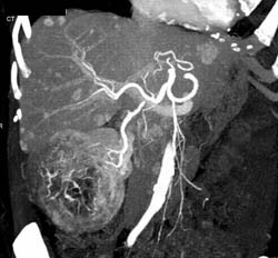 Renal Cell Carcinoma With Vascular Liver Metastases - CTisus CT Scan