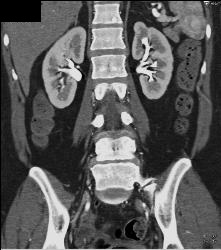 Scarring Left Kidney - CTisus CT Scan