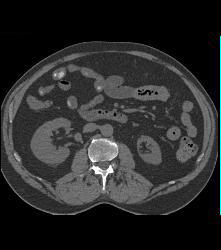 1cm Right Renal Artery Aneurysm - CTisus CT Scan