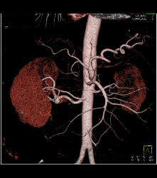 1cm Right Renal Artery Aneurysm - CTisus CT Scan