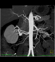 1cm Right Renal Artery Aneurysm - CTisus CT Scan