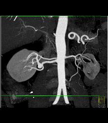 1cm Right Renal Artery Aneurysm - CTisus CT Scan