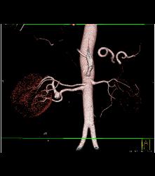 1cm Right Renal Artery Aneurysm - CTisus CT Scan