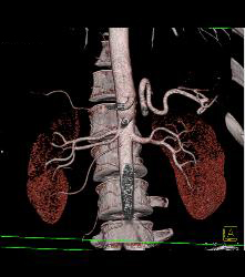 Multiple Right Renal Arteries - CTisus CT Scan