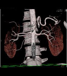 Multiple Right Renal Arteries - CTisus CT Scan